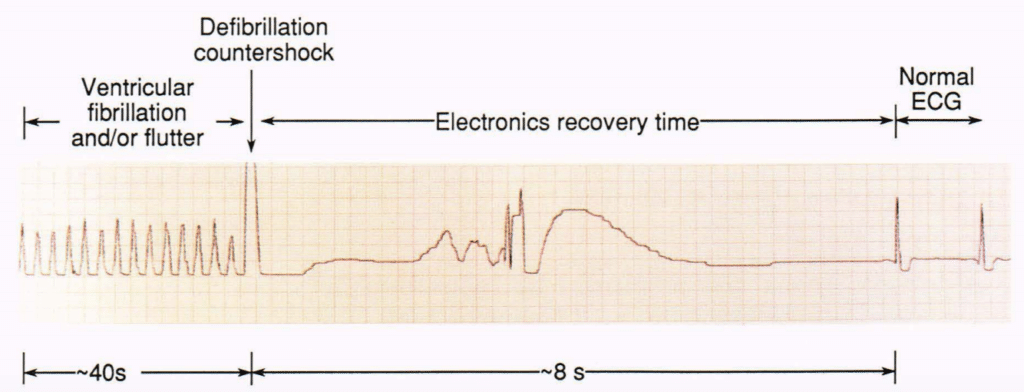 The invention of the ICD - Sudden Cardiac Arrest UK